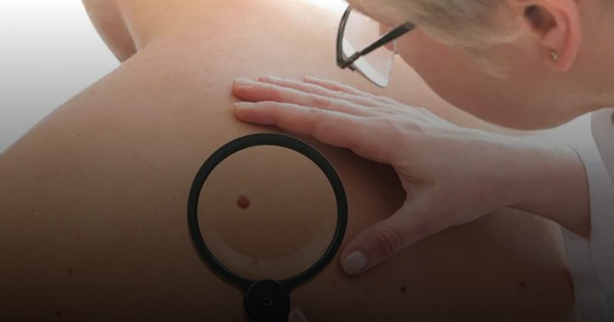 علاج يستخدم مرة واحدة يساعد مرضى سرطان الجلد على العيش مدة أطول