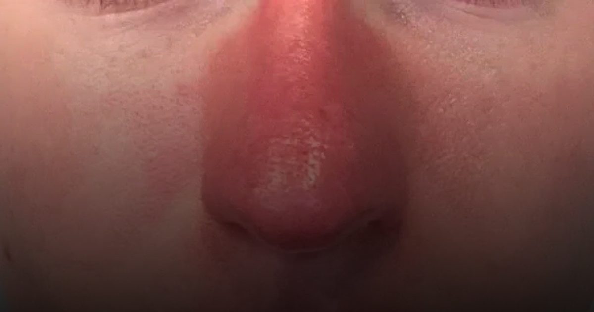 "الوردية".. حالة جلدية تسببها حروق الشمس