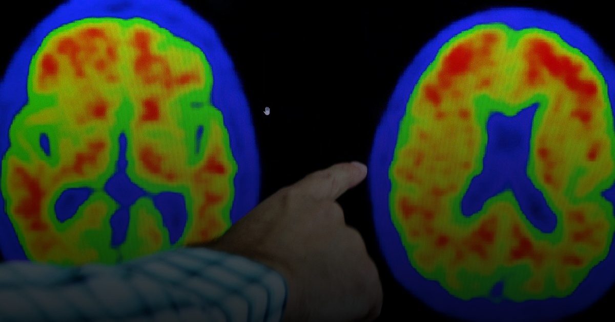 أستراليا: تعديل نمط الحياة  يساهم في خفض معدلات الإصابة بالخرف والزهايمر