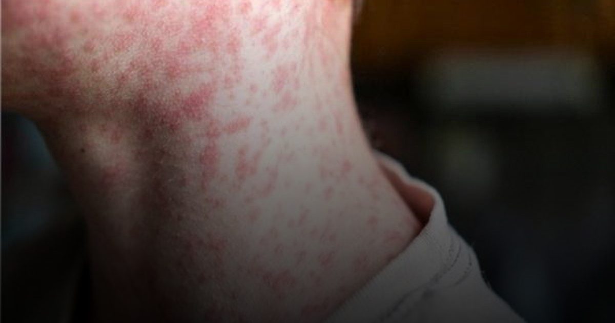 أكثر من ألف حالة إصابة بالحصبة في أمريكا