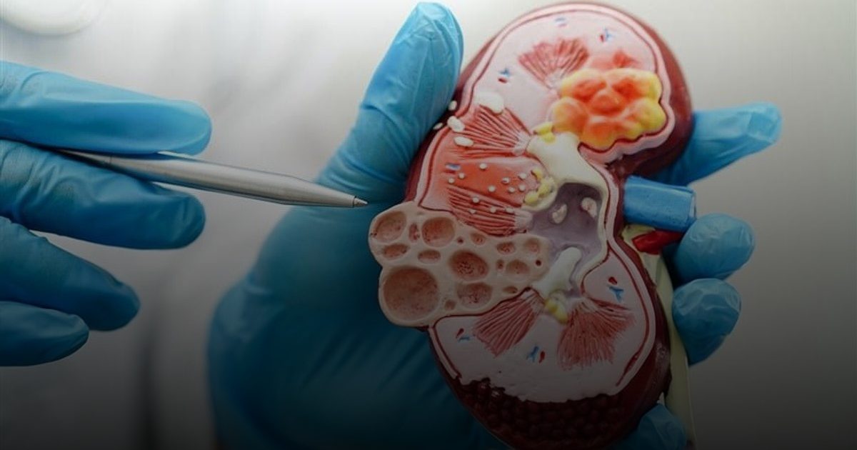 مرض الكلى المزمن يدخل قائمة "أكثر 10 أسباب للوفاة عالميًا" لأول مرة