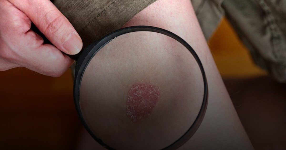 أنظمة غذائية نباتية قد تساهم في تهدئة الصدفية