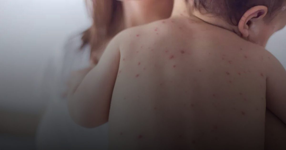 الحصبة تدق الأبواب من جديد.. إصابة 60 طفلاً بلندن بسبب عدم تلقى اللقاح