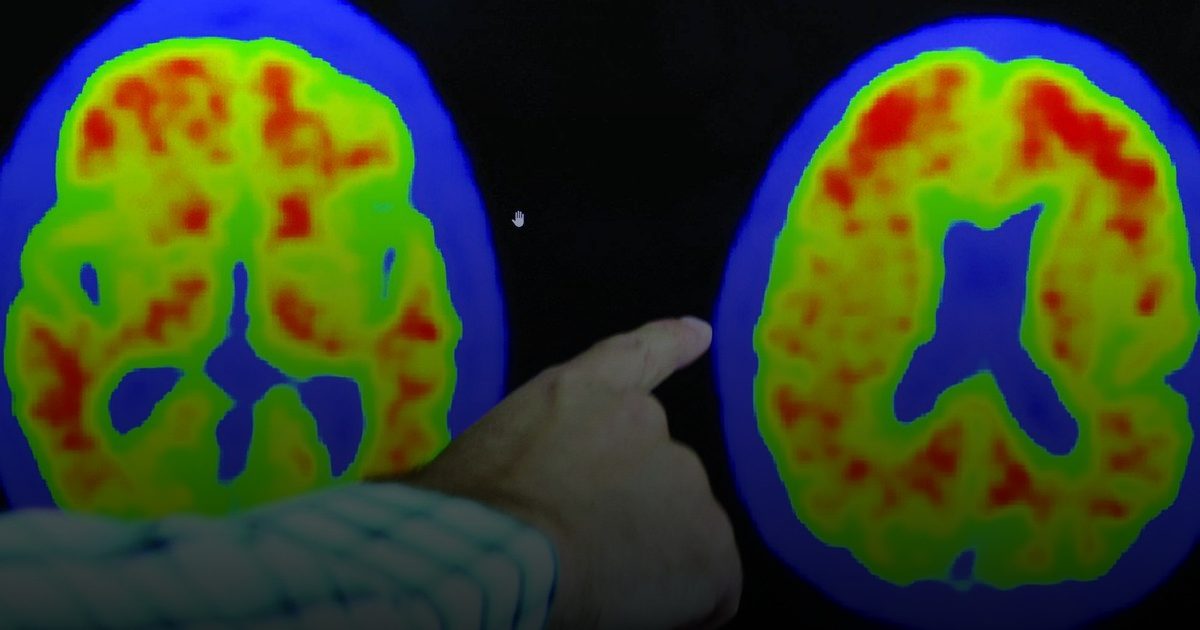 أدوية لعلاج فيروس نقص المناعة البشرية قد تتصدى لـ "ألزهايمر"