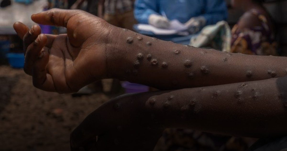 ارتفاع حالات الإصابة بفيروس جدري القرود في غانا