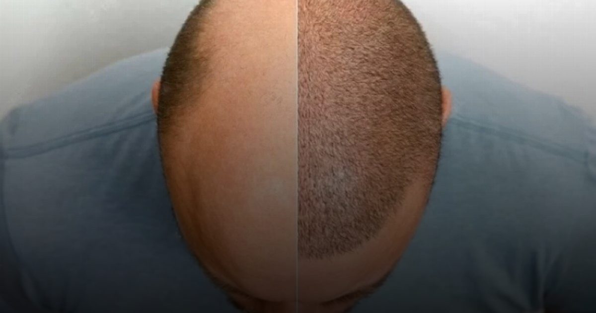 الروبوتات تهزم «الصلع» في المملكة.. نمو متوقع لسوق زراعة الشعر بـ 432 مليون دولار بحلول 2033