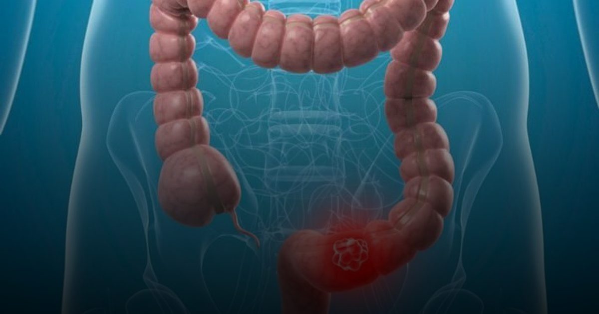الفحص في سن الأربعين يقلل وفيات سرطان القولون بنسبة 39%
