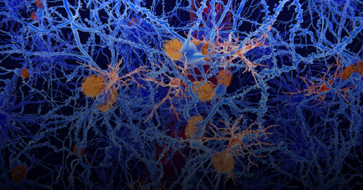 باحثون يكتشفون علاجاً لصرع "الفص الصدغي" عبر إزالة الخلايا الهرمة