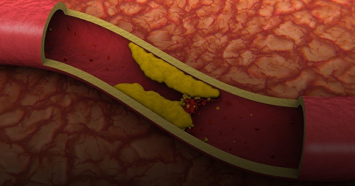 حقنة "تعديل جيني" واحدة لإنهاء معاناة الكوليسترول الوراثي للأبد