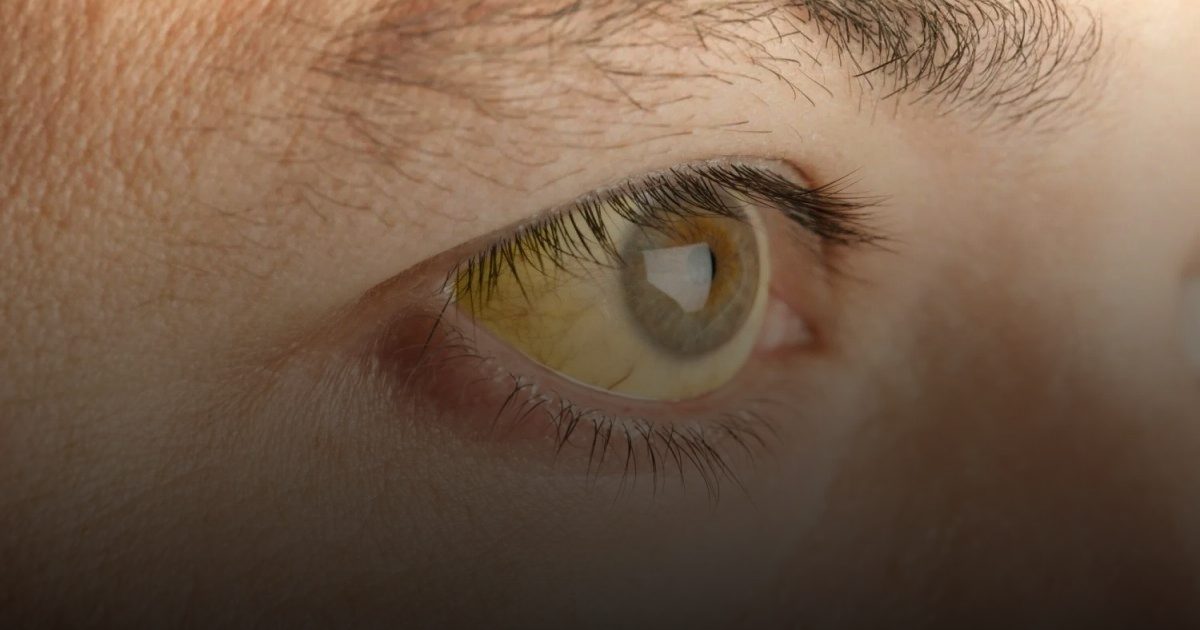 اكتشاف إنزيم في بكتيريا الأمعاء يمنع اليرقان