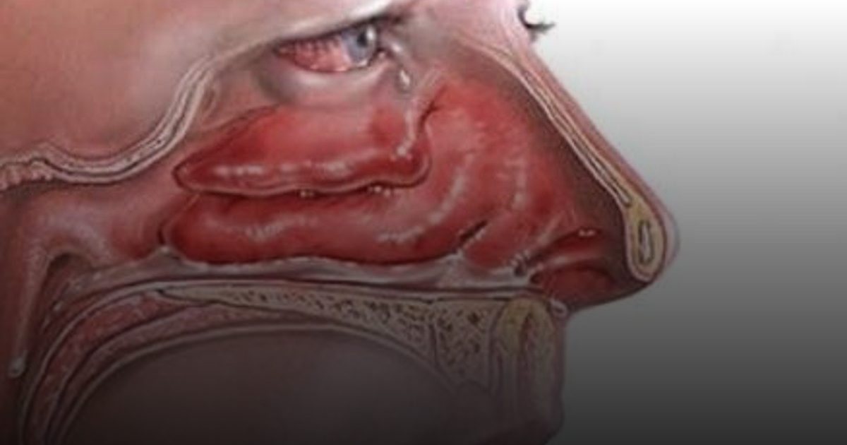 10 علامات تحذيرية لـ "سرطان الأنف".. والرجال الأكثر عرضة للإصابة