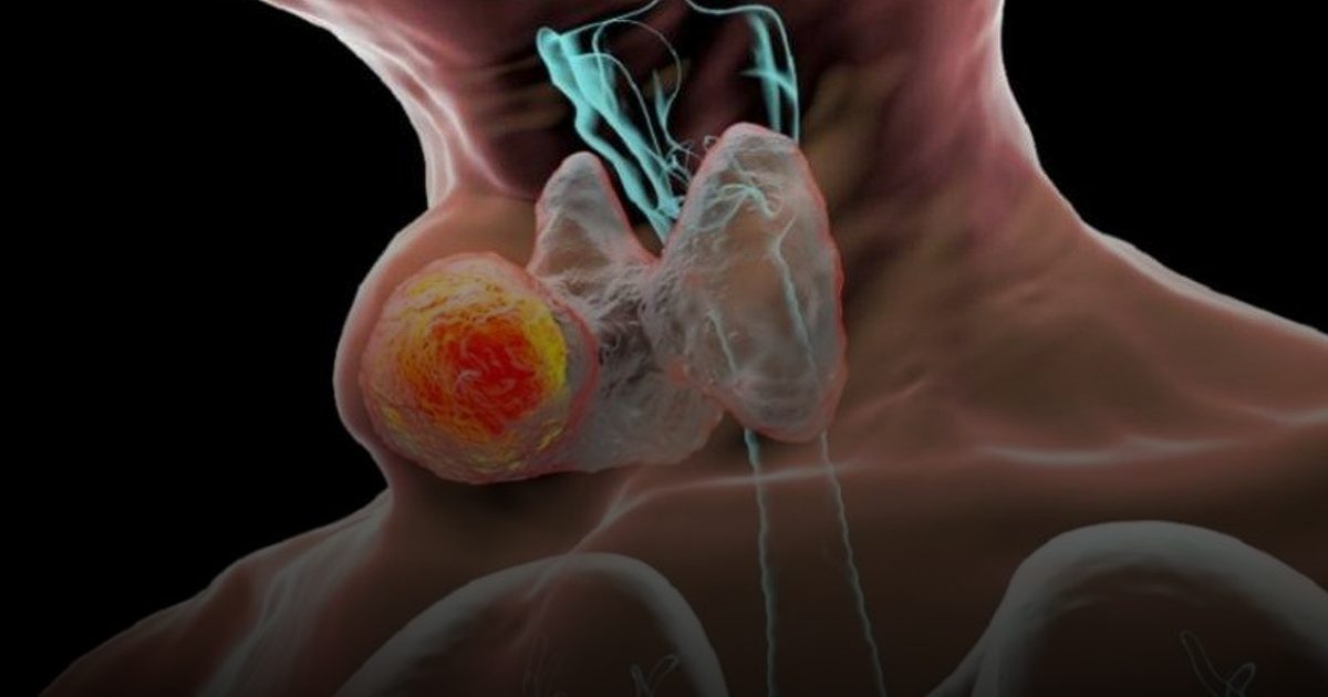 علاج مناعي جديد يساعد مرضى سرطان "الرأس والرقبة" على وقف تفاقم المرض