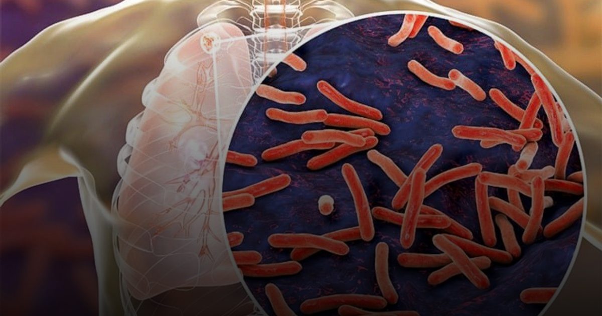 العلم يقترب من التغلب على السل أخطر مرض في العالم