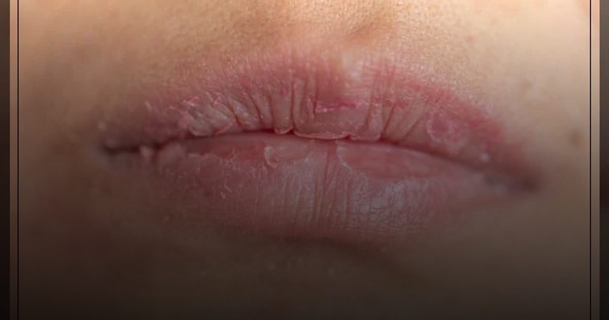 الشفاه قد تكشف أسراراً خطيرة عن الصحة