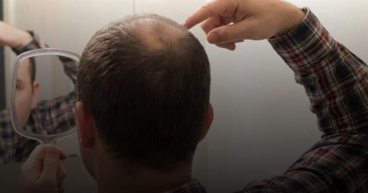 "كلاسكوترون": أول علاج موضعي للصلع يعيد نمو الشعر دون آثار هرمونية عامة