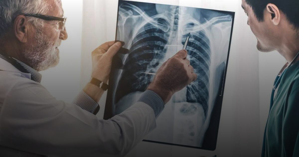 بين سرطان الرئة والنظام الغذائي علاقة وطيدة