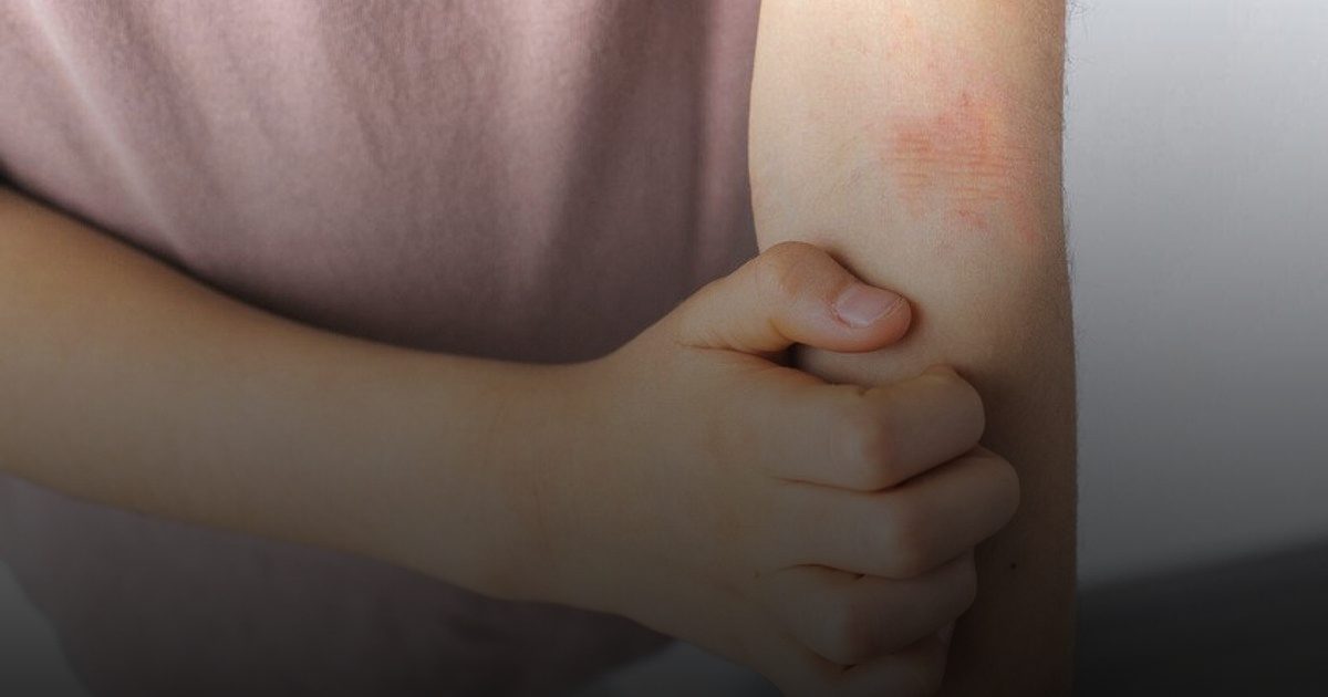 أمراض جلدية تتفاقم في الخريف والشتاء.. نصائح للتعامل مع الإكزيما والصدفية