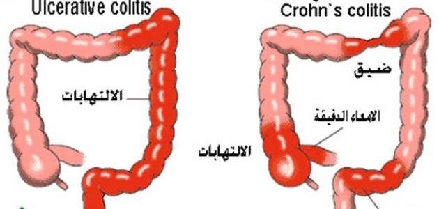 FDA  الأمريكية توافق على دواء لتخفيف أعراض مرض كرون الشديد