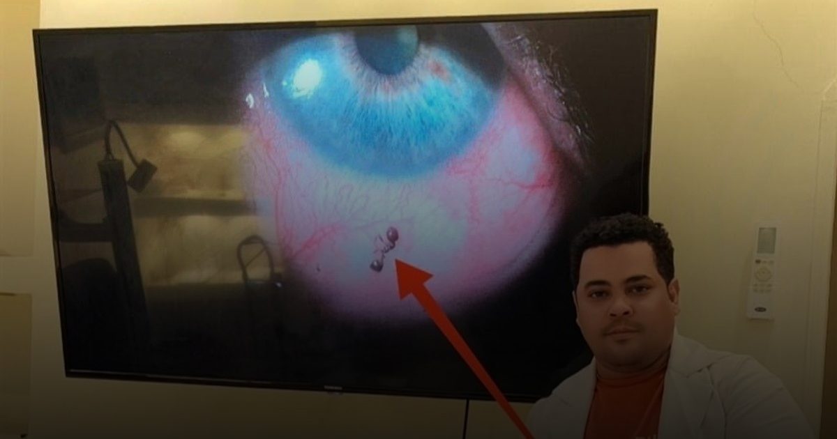 طبيب مصري ينقذ مريضة من نملة غرست في عينها