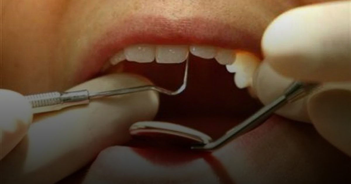 باحثون: الكيراتين المستخلص من الشعر قد يعالج تلف مينا الأسنان ويوقف التسوس