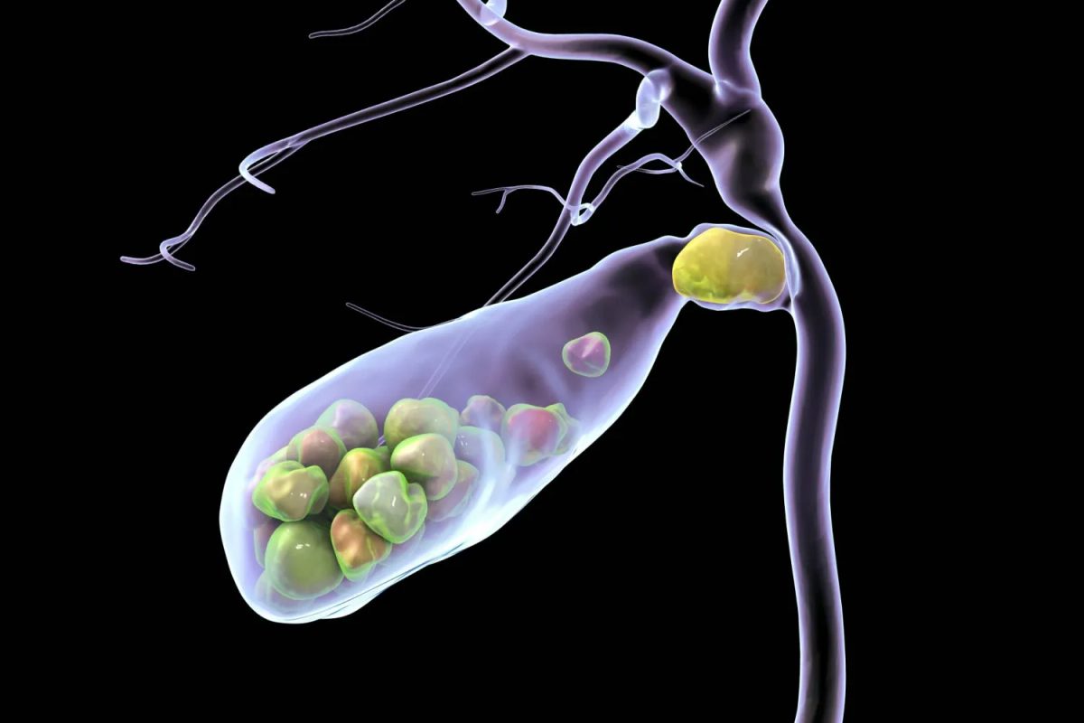 كثرة السكر تهدد صحة المرارة: حصى بنسب متصاعدة