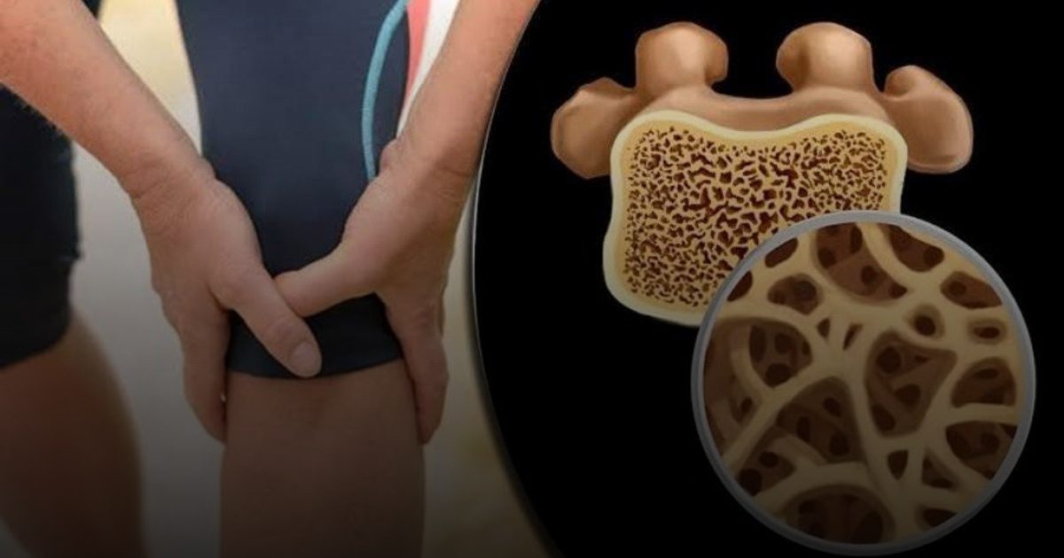 هشاشة العظام.. مرض صامت يهدد امرأة من كل 3 فوق الخمسين