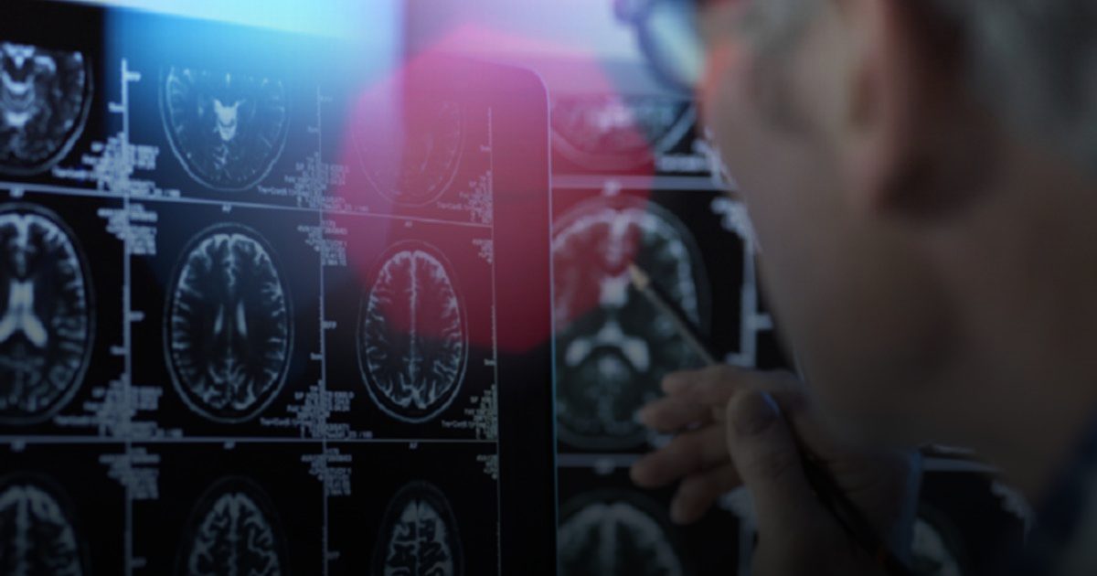 أدوية متداولة في سباق مواجهة ألزهايمر