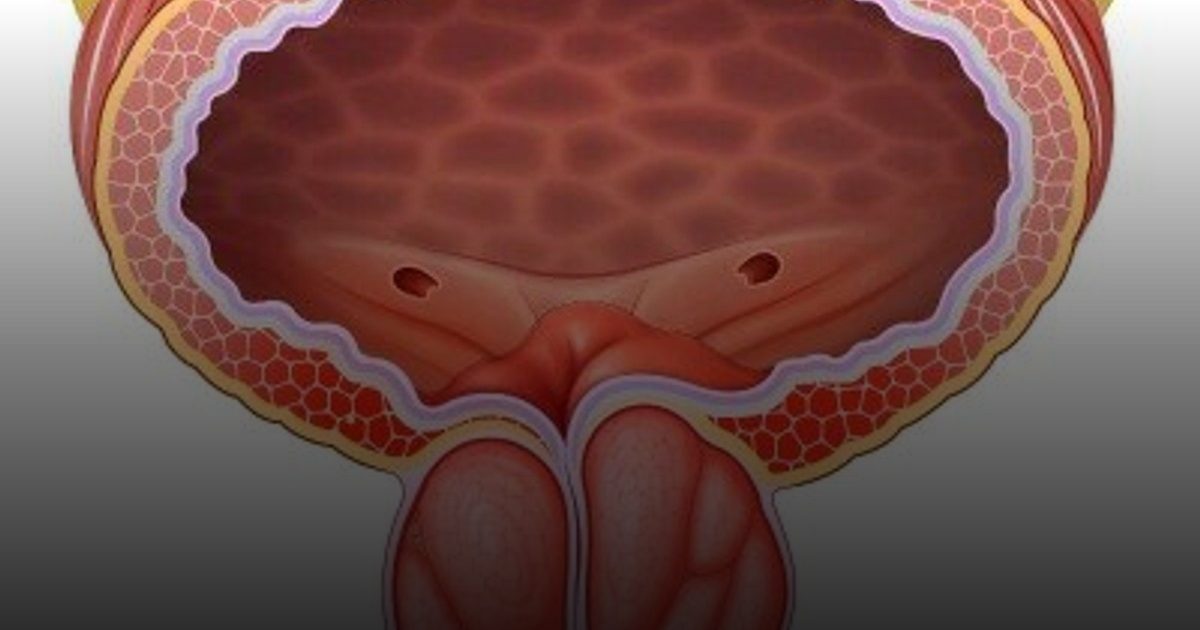 تقدم طبي في علاج سرطان البروستاتا المبكر