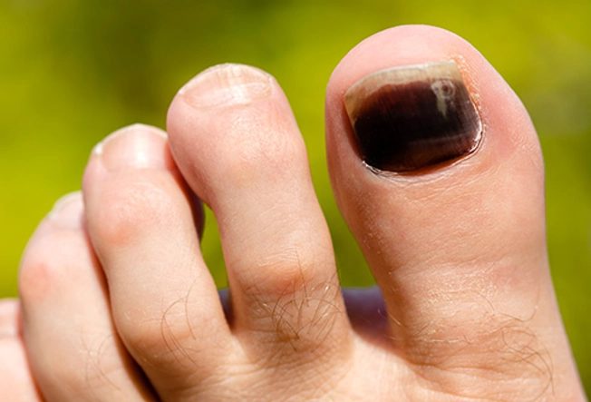 كمادات باردة تقي أظافرك من التشوه والانفصال الجزئي