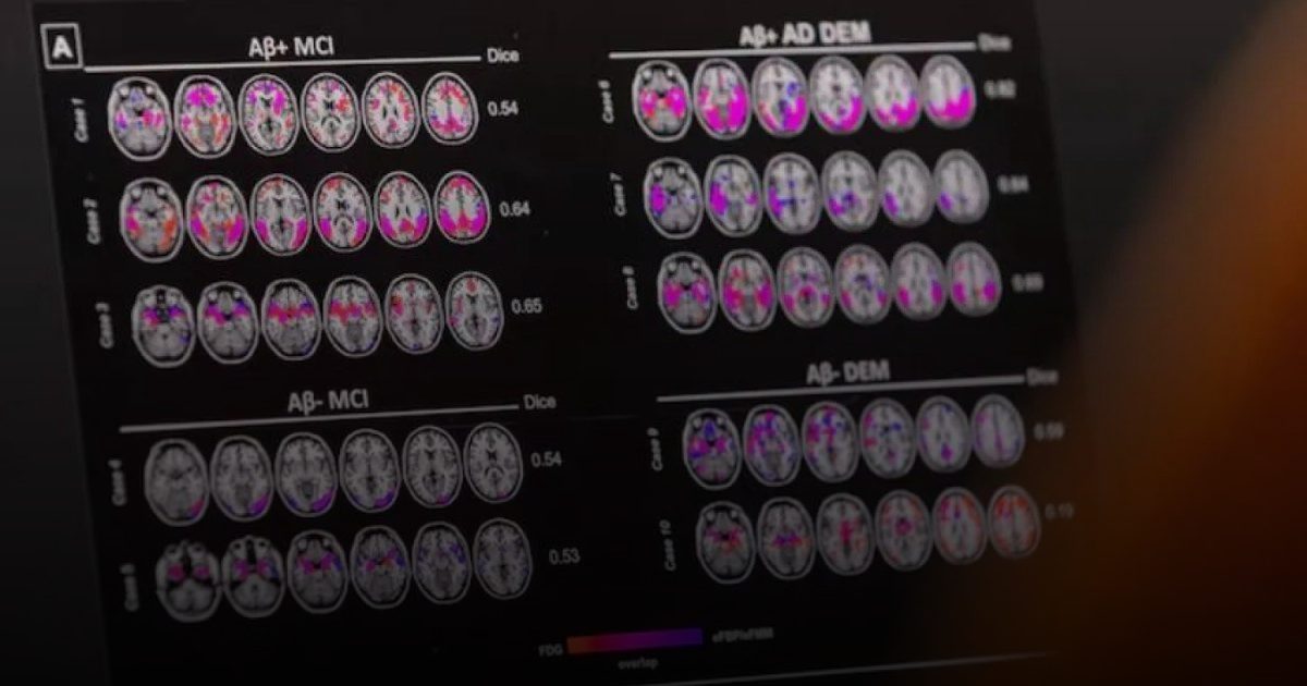 "صحة الدماغ تبدأ من الألحان".. الموسيقى تنضم لقائمة الأنشطة الوقائية ضد الخرف