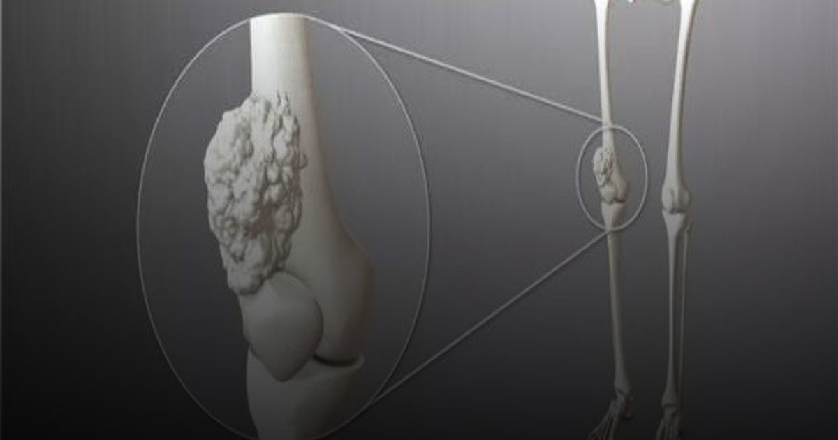 فقدان الوزن والتعب المستمر.. أعراض مفاجأة لسرطان العظام