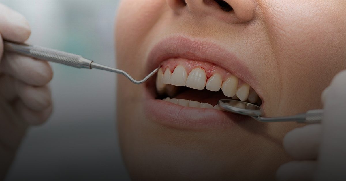 نزيف اللثة قد يكشف نقصًا خطيرًا في فيتامين C