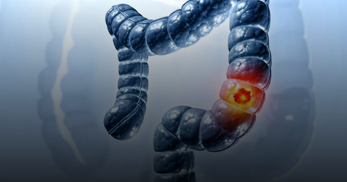 عقار علاج مناعي يسجل نتائج واعدة في محاربة سرطان القولون