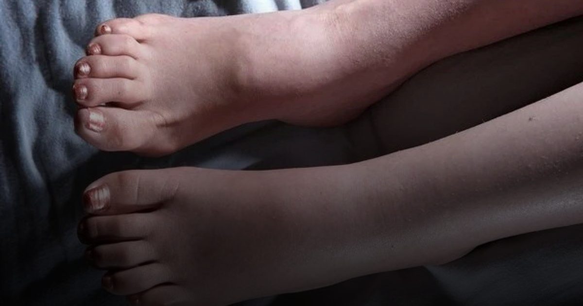أعراض تصاحب تورّم الكاحل تنذر بخطر شديد