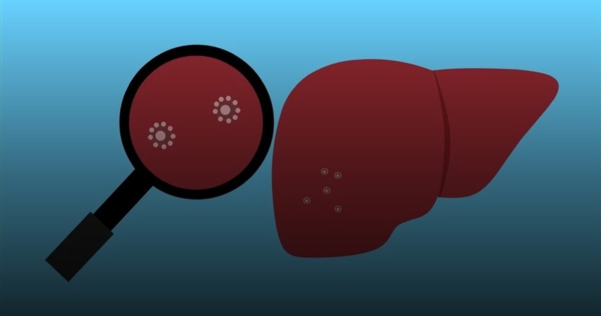 حقائق جديدة عن احتمالات الوقاية من سرطان الكبد