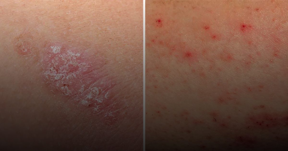 حقنة "نيموليزوماب" تمنح مرضى الإكزيما راحة من الحكة خلال 48 ساعة