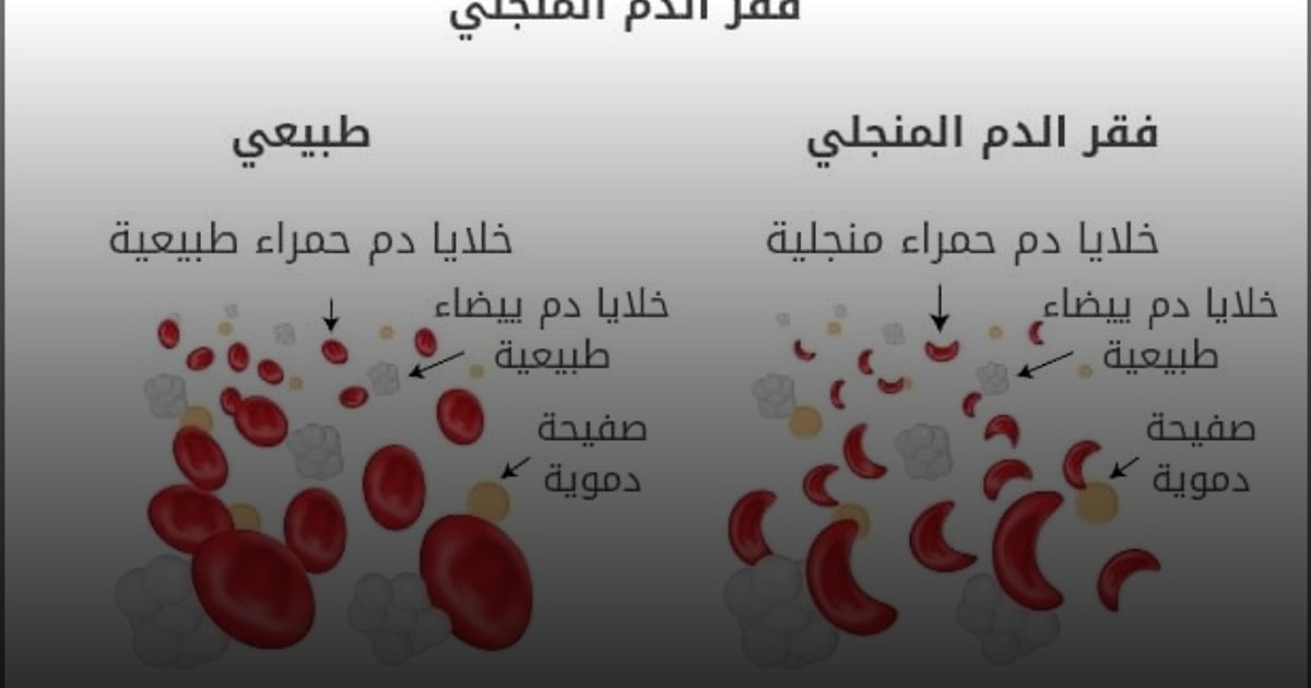 التوعية بتفاصيل مرض فقر الدم المنجلي ودعم المصابين به وتشخيصهم سريعًا