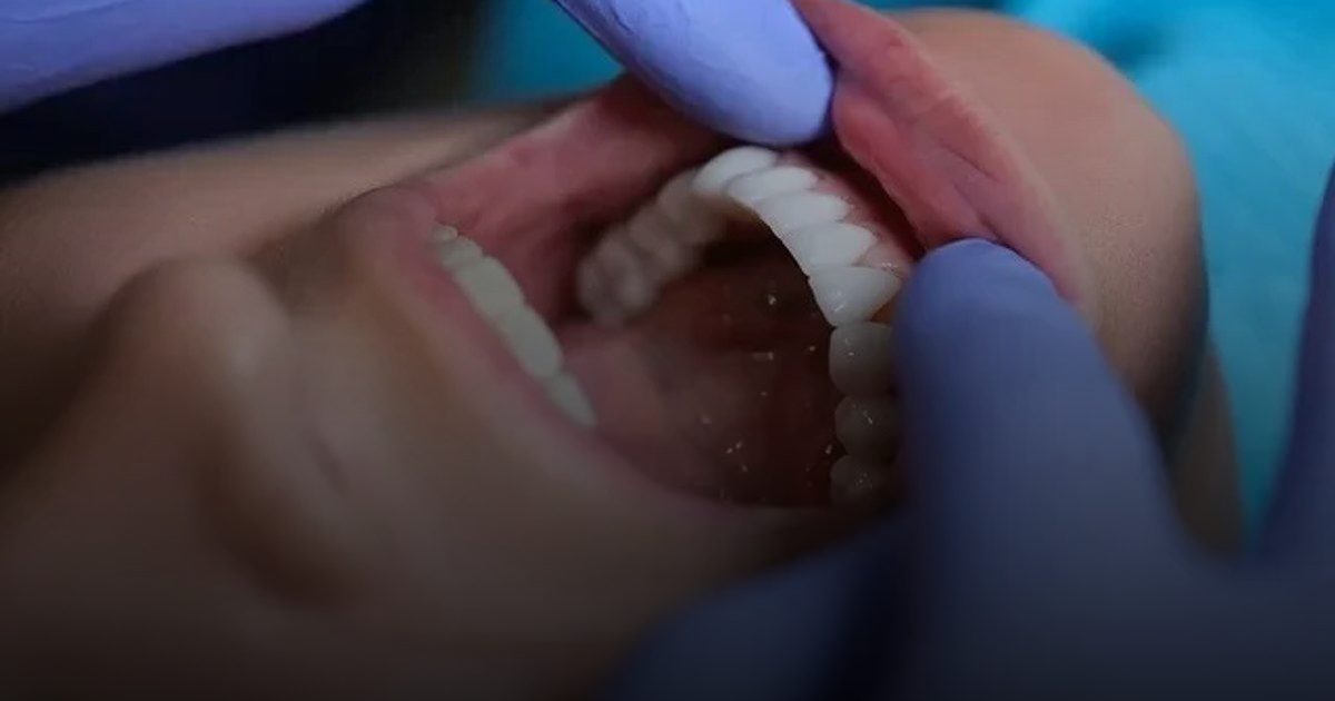 ضعف الأسنان علامة على أمراض القلب والسكري والكلى