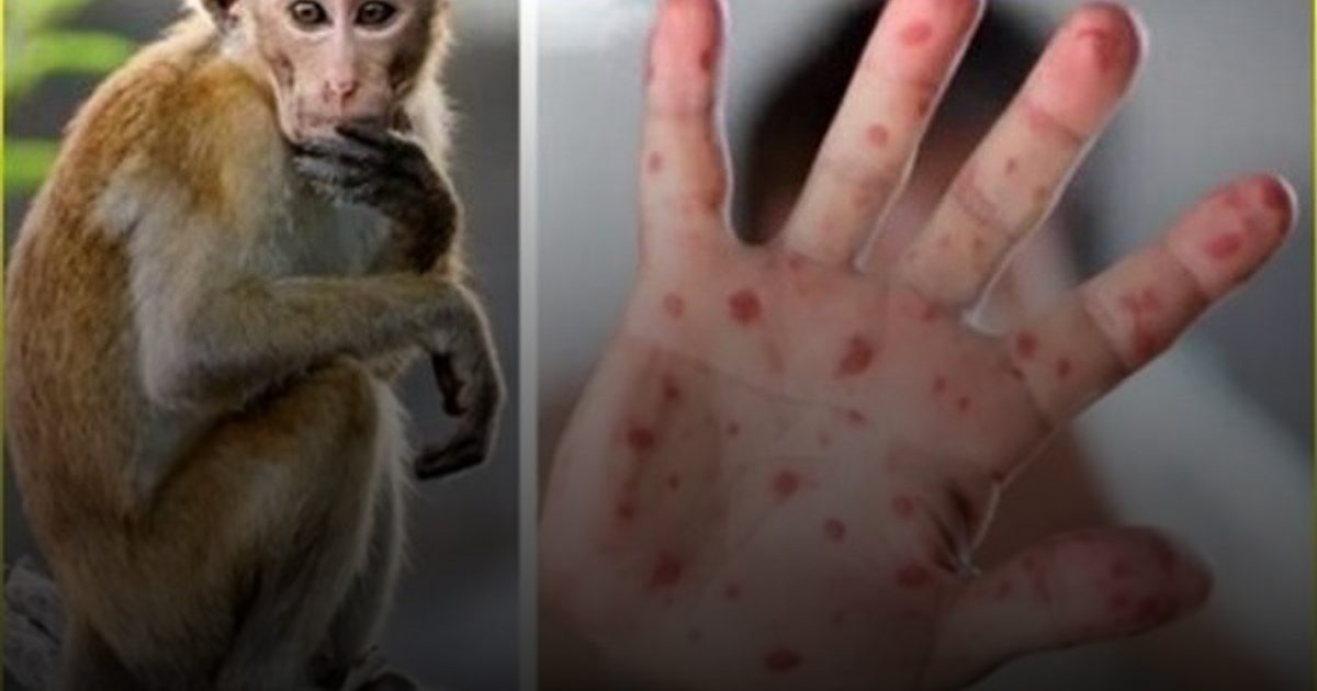 سيراليون تسجل زيادة في إصابات جدري القردة بنسبة 71% خلال أسبوع