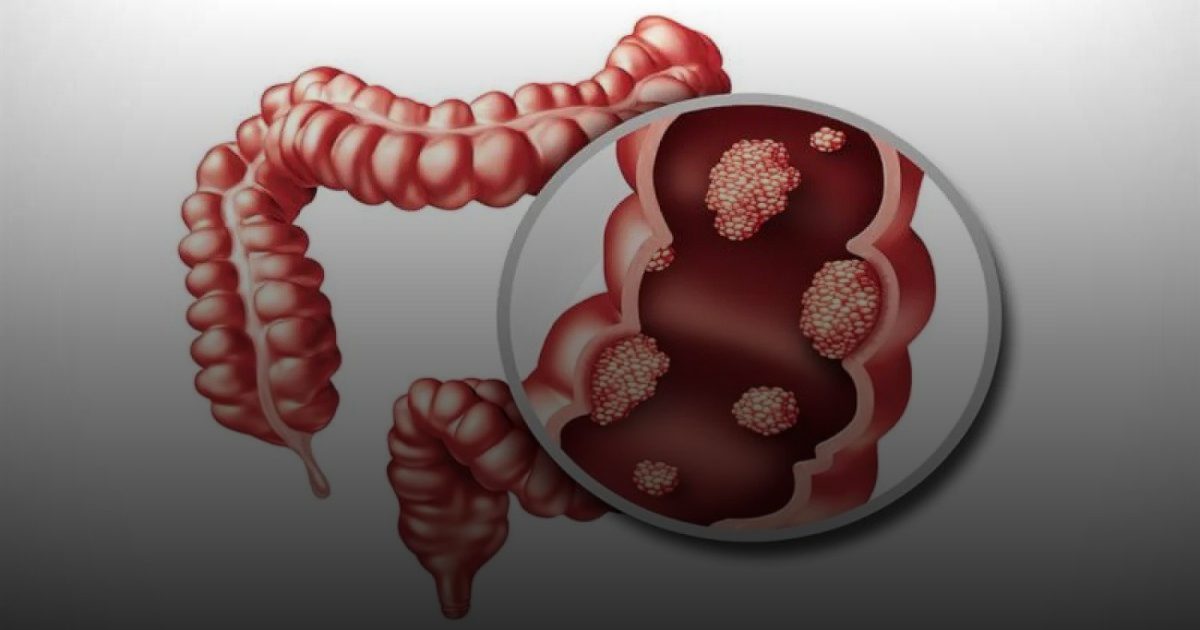 علماء يكشفون عن وجبة خفيفة قد تقلل من خطر الإصابة بسرطان القولون
