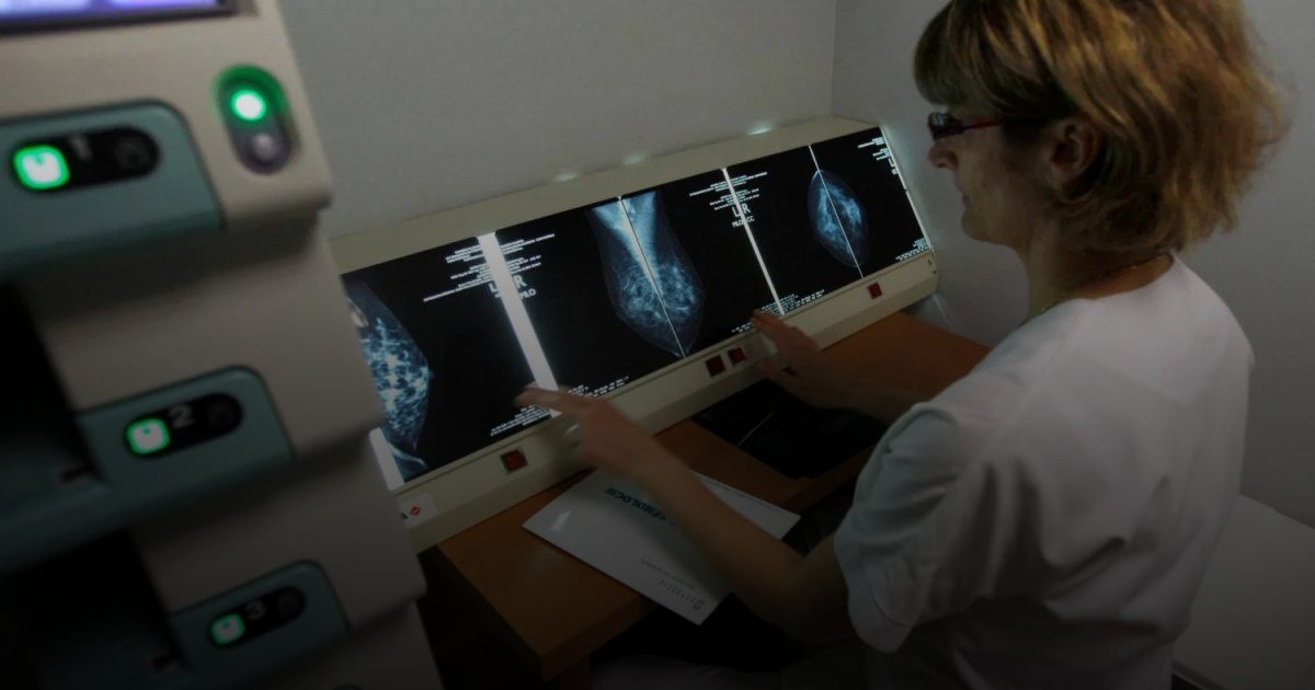 تجاهل "الماموغرام" الأول يرفع خطر الوفاة لسرطان الثدي بنسبة 40%