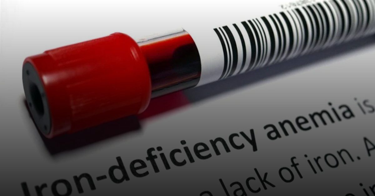نقص الحديد يزيد احتمال الإصابة بسكتة دماغية لدى الشباب
