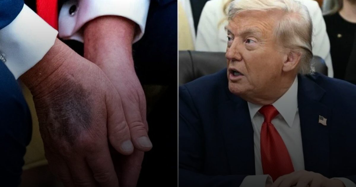 "خديعة الجرعة العالية".. تحذيرات طبية بعد اعتراف ترمب عن الأسبرين