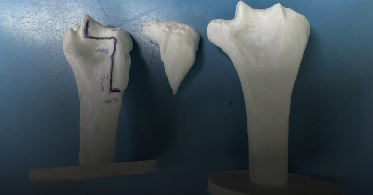 الملك فهد الجامعي يحقق إنجازًا نوعيًا بزراعة عظم ومفصل لشاب في مقتبل العمر