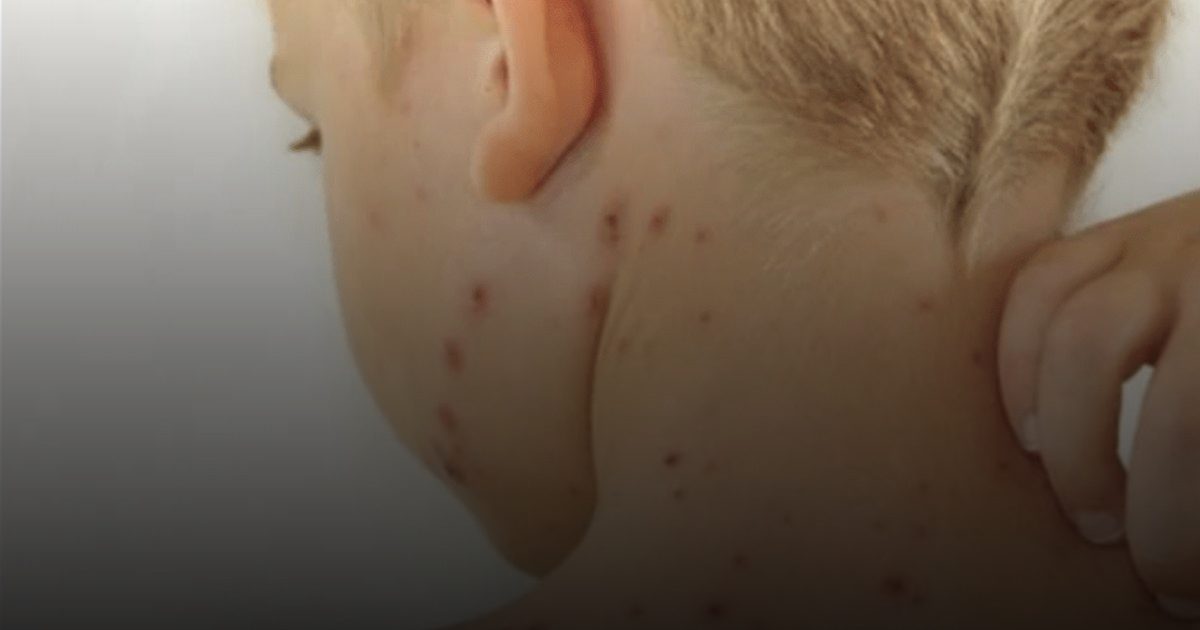 الجرب يغزو المملكة المتحدة بمعدلات قياسية