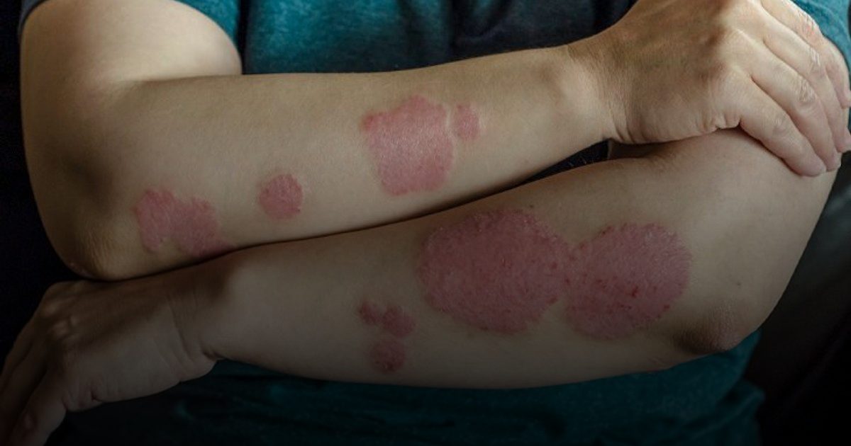 عن الصدفية .. الصحة العالمية والخبراء يدعون لرفع الوعي ومكافحة الوصمة