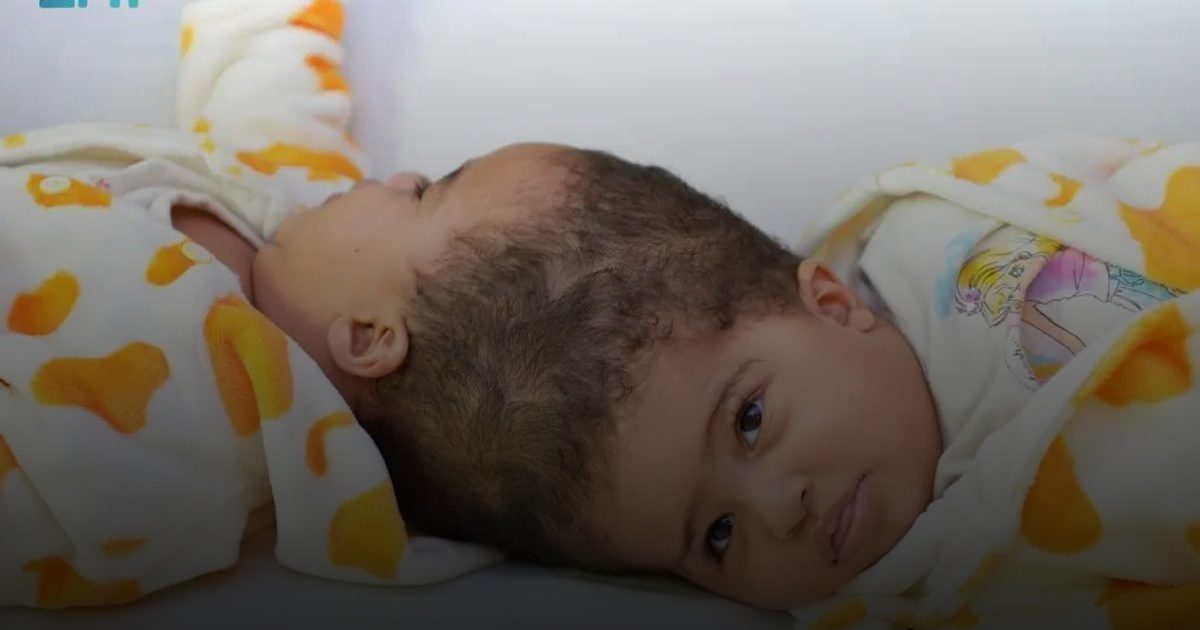 نجاح عملية فصل التوأم الملتصق الإريتري "أسماء وسمية"