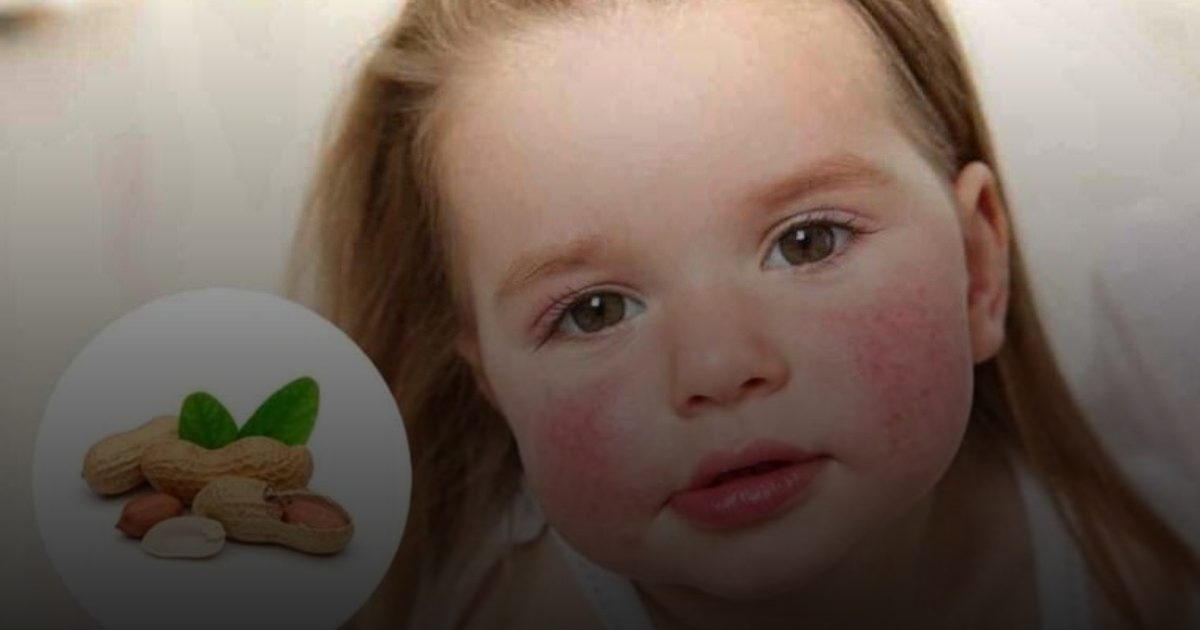 لصقة طبية جديدة تحمي الأطفال من حساسية قاتلة للفول السوداني