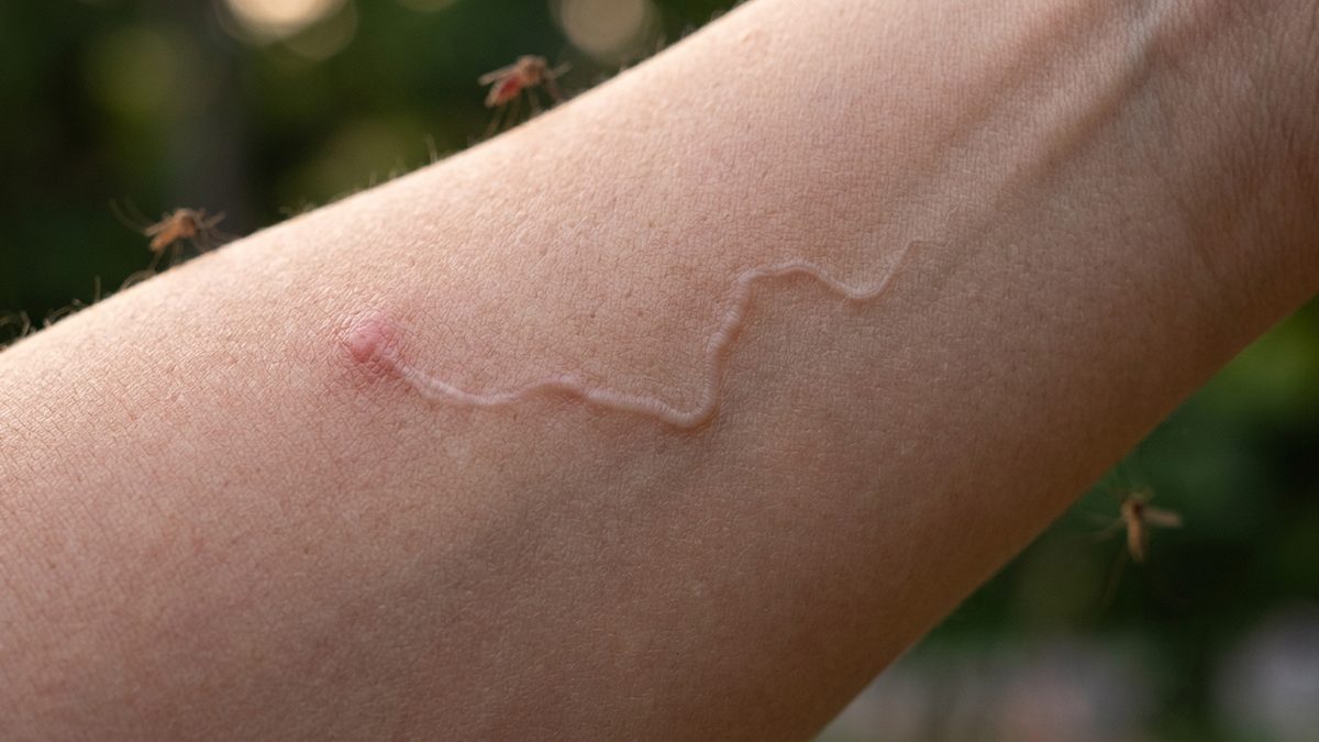 داء الديدان الخيطية: خطر صحي غير متوقع من لدغات البعوض
