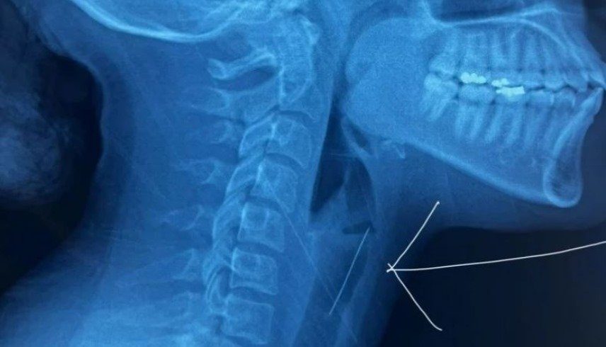 عادة شائعة تخنق فتاة مغربية.. بسبب دبوس ابتلعته